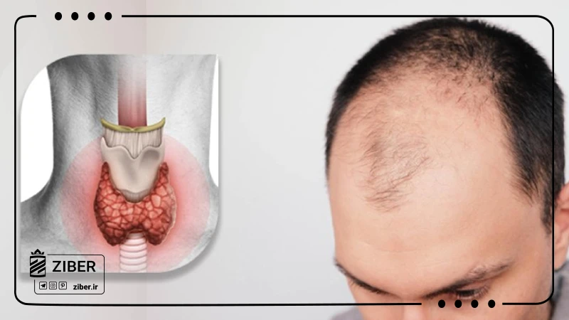 نقش اختلالات تیروئید در ریزش مو